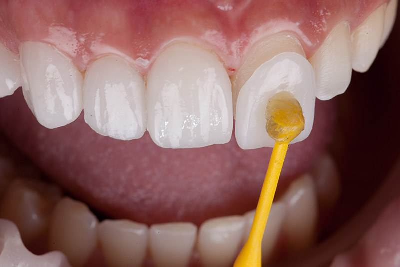 Cosmetic Dentistry in Chicago